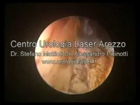 Intervento chirurgico sul adenoma prostata con laser Recensioni di candele farmaci vitaprost