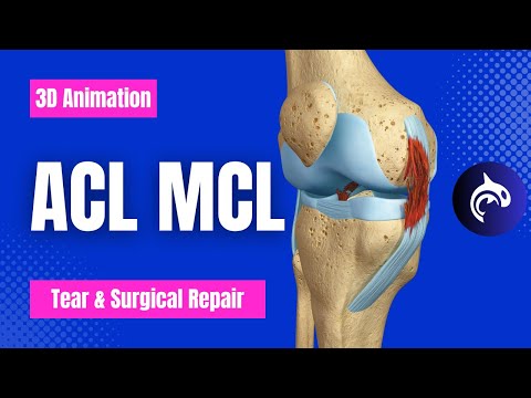 ACL MCL Riss und Reparatur - 3D-Animation