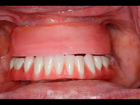 Step-by-Step  All-on-Four Dentures: Part 3: Jaw Relations #allonx #allon4