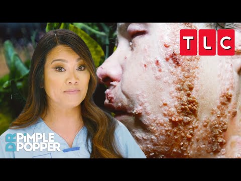 Strangest Skin Conditions | Dr. Pimple Popper | TLC