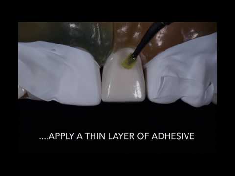 Porcelain Veneer Cementation step by step technique