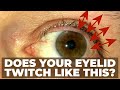 Eyelid spasms, Twitches, twitching driving me crazy. Upper eye lid vibrating, is this normal?