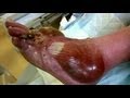 Pus Filled Blisters - Bizarre ER