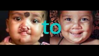 Operation Smile: Cleft to Smile