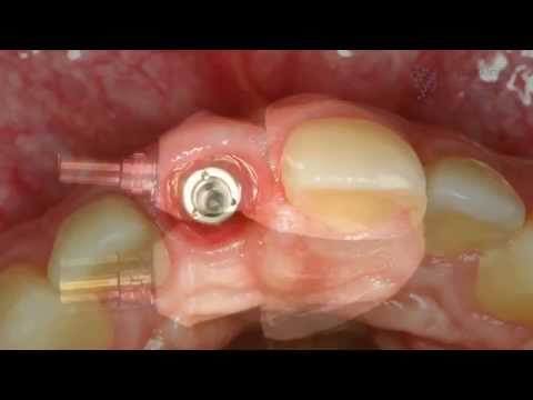 Zahnimplantate einsetzen - Erklärfilm mit Vorher Nachher Bildern