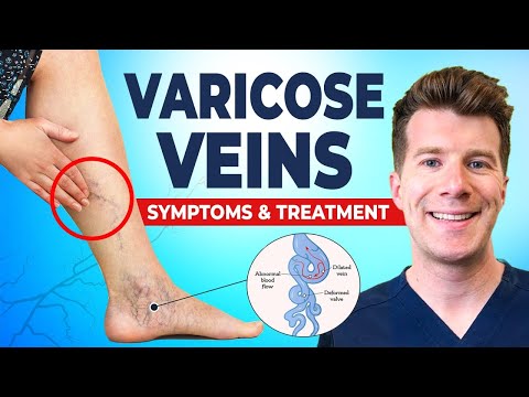 Varicose Veins Explained: Causes, Symptoms & Treatment