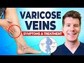 Varicose Veins Explained Causes Symptoms Treatment