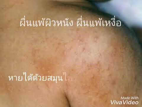 การรักษาด้วย homeopathy neurodermatitis ครีมสำหรับโรคสะเก็ดเงินด้วย SDA-3