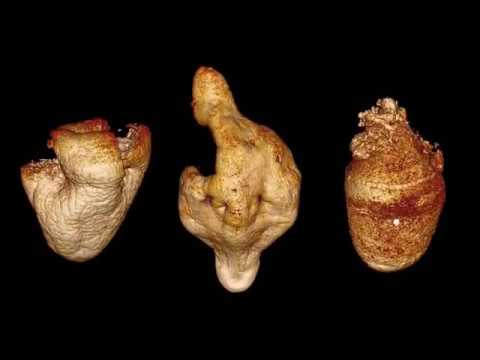 szemölcsök a moxibustionig nőknél osztályozza a nemathelminthes dan annelida