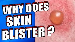 Why Does Skin Blister |  How To Treat & Prevent Skin Blisters Naturally