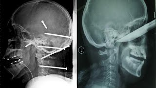 10 ПОРАЗИТЕЛЬНЫХ ВЕЩЕЙ, НАЙДЕННЫХ ВНУТРИ ЧЕЛОВЕКА