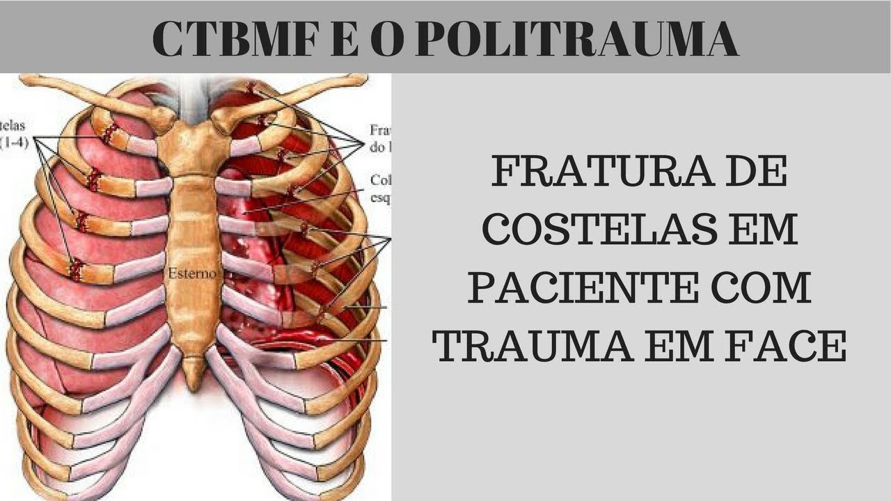 FRATURA DE ARCOS COSTAIS