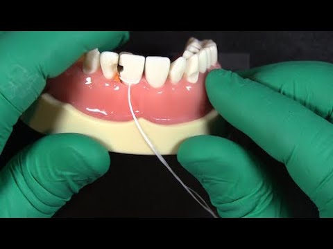 Use this floss trick to seal your matrix bands for anterior restorations