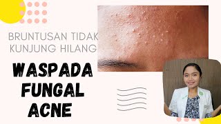 Download lagu Causes of acne breakouts which hard to go away? Beware of Fungal Acne | dr. Emasuperr mp3 Download lagu Causes of acne breakouts which hard to go away? Beware of Fungal Acne | dr. Emasuperr mp3