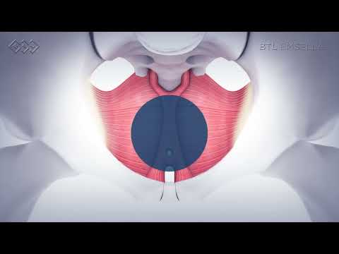 Система высокоинтенсивной магнитотерапии BTL-6000 Super Inductive System Locus (Esmella)