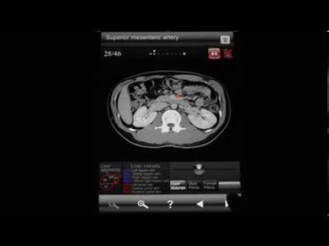 Abdominal CT Sectional Walker Video