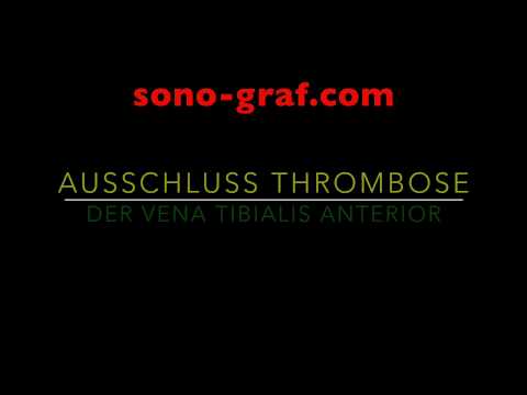 007 - Duplexsonografie - Ausschluss Thrombose der Venae tibialis anterior