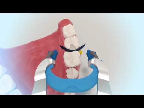 myQuickmat Classico kit - Polydentia