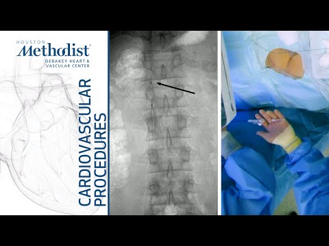 Standard IVC Filter Retrieval (Alan B  Lumsden, MD, Peter Osztrogonacz, MD)
