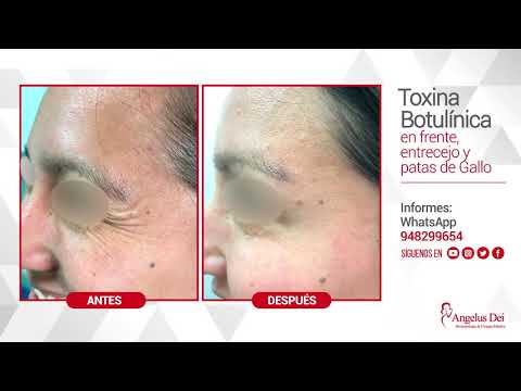 Antes y Después – Toxina Botulínica