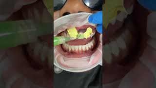 Gap closure using composite bonding ☁️🤍