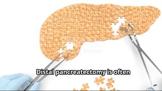 My Distal Pancreatectomy Experience: What to Expect