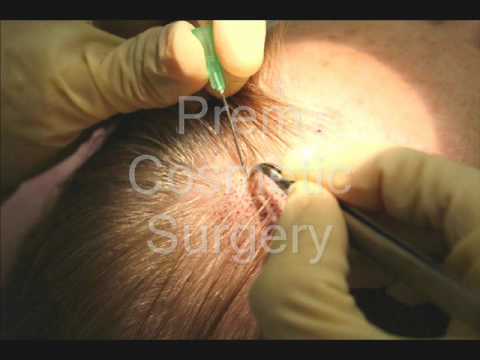 hair loss treatment in India.wmv