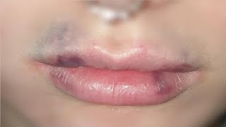how to get rid of bruised lip after kissing easy trick