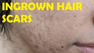 how to get rid of ingrown hair scars on face
