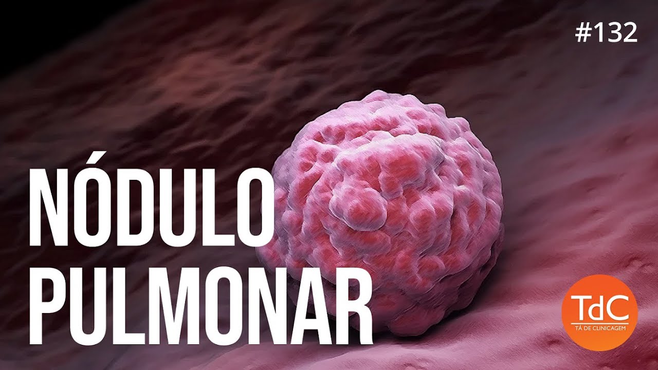 Nódulo Pulmonar: Episódio 132
