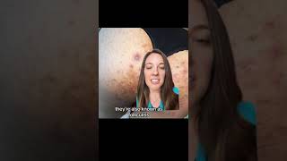 Yes Butt Acne Happens Too | How to Treat