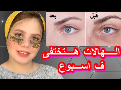 اسهل  5 طرق لعلاج الهالات السوداء/تجنبى هذه العادات اليوميه(هى سبب الهالات)❌ هنا hana