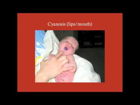 Surgery of Cyanotic CHDs - CRASH! Medical Review Series