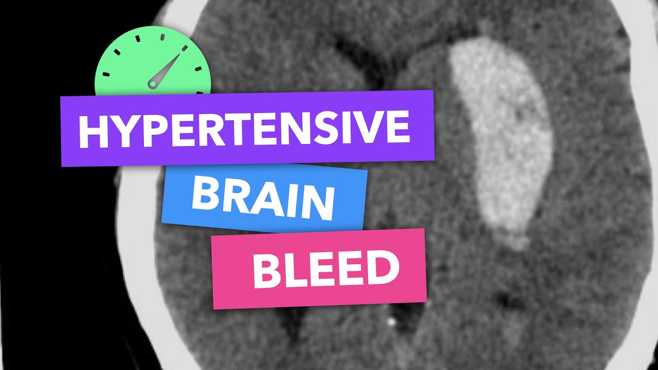 Hypertensive brain bleed - Radiopaedia's Emergency Radiology Course