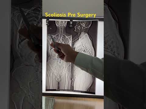 What is Scoliosis and how to treat it - Dr. Ajay Kothari