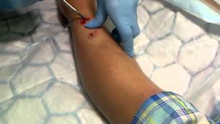 Big splinter being pulled from leg