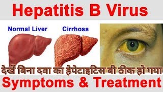 preview picture of video 'Hepatitis B cure without treatment'