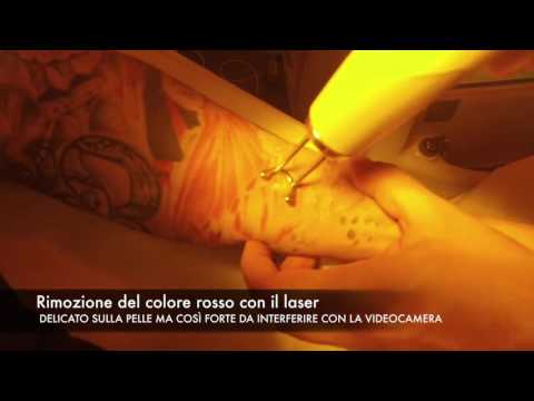 Il trattamento di posti di pigmentary su una faccia è medicamentous Come togliere una macchia scura dopo unescoriazione su una faccia