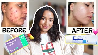 MY FULL DOXYCYCLINE EXPERIENCE FOR ACNE| Antibiotics for acne /Clearing acne, derma roller for face