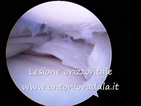 Dolore nella parte destra nella regione lombare della schiena Ipertensione in osteocondrosi cervicale