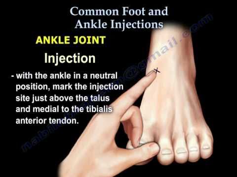 Common Foot And Ankle Injections - Everything You Need To Know - Dr. Nabil Ebraheim