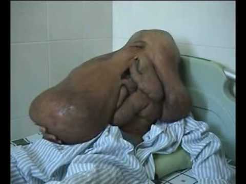 Imagini IREALE cu &bdquo;Omul-elefant&rdquo;. O tumoră gigantică l-a transformat pe un chinez &icirc;ntr-o ciudățenie a naturii!