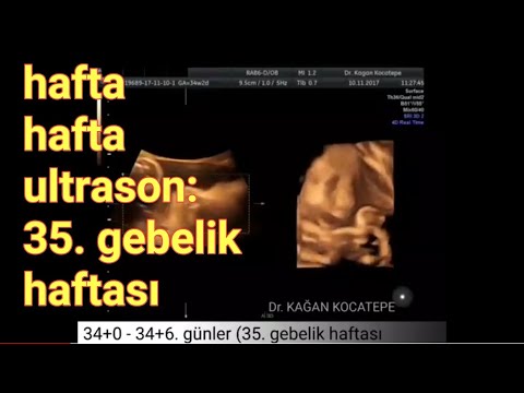 35. gebelik haftasında anne karnındaki bebek - açıklamalı ultrason görüntüleri