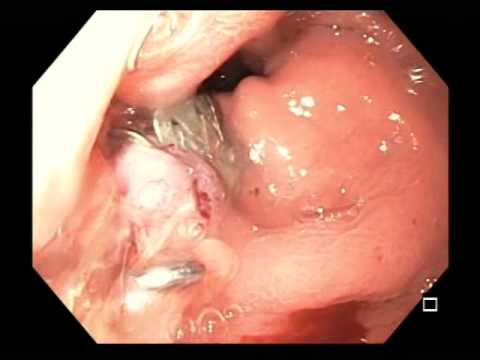 Ovesco Clips After Repair of Gastric Sleeve Leak.