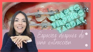 Cuánto tiempo tarda en cerrar un espacio después de extracciones