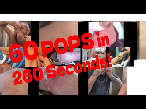 60 Pops in 260 seconds! Cyst, Zip, Pimple, Abscess pops and more! Plus a chance to win merch