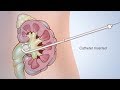 Nephrostomy