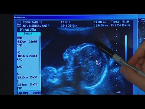 FDA issues warning over non-invasive prenatal screenings