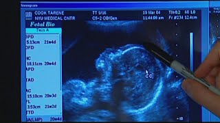 FDA issues warning over non-invasive prenatal screenings
