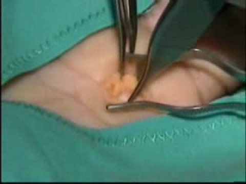 Schmerzen im unteren Rücken und Becken bei Männern Osteochondrose der Hals Brust-Diagnose Beispiele